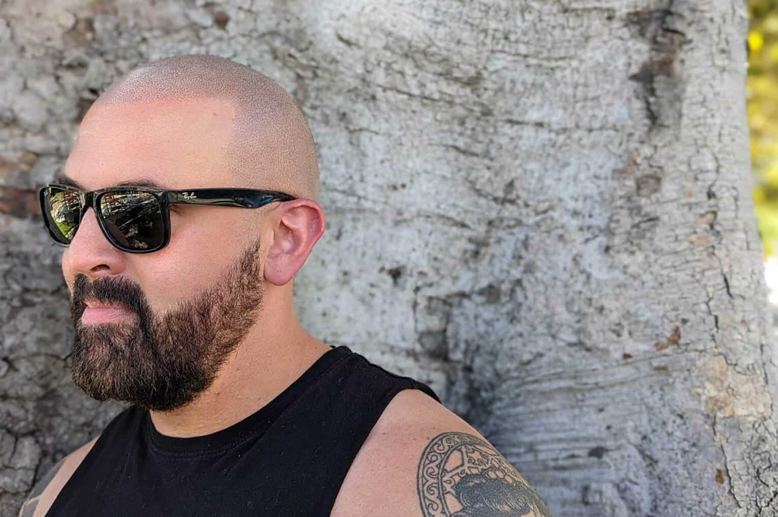 What is scalp micropigmentation