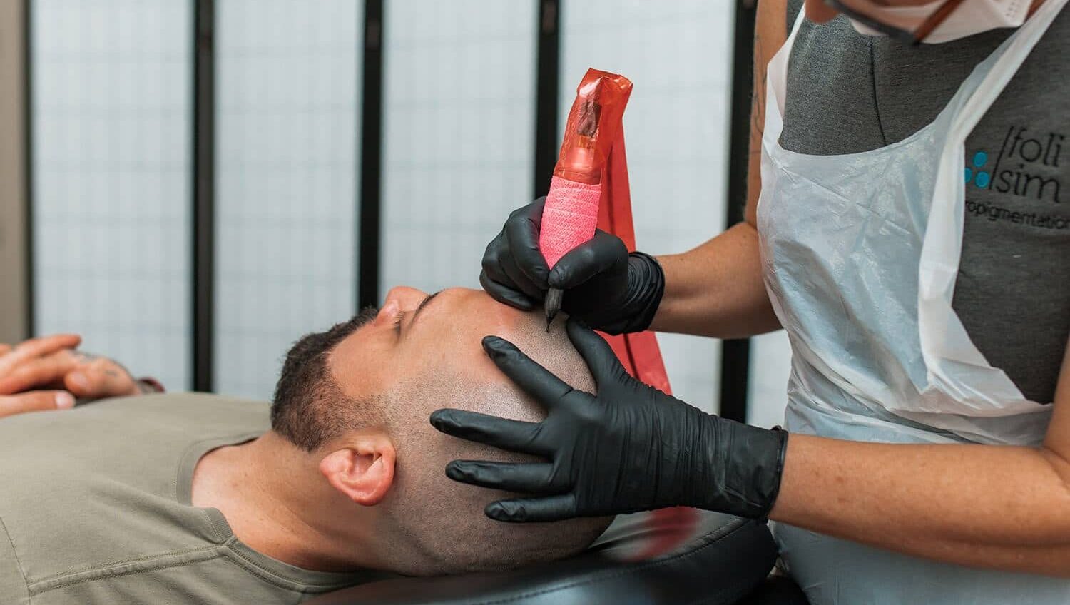 What scalp micropigmentation costs: discussed at a free Foli Sim consultation