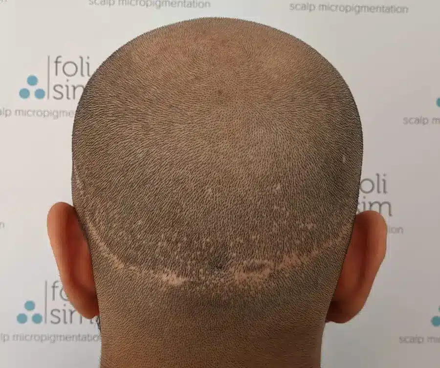 A hair transplant scar camouflaged with scalp micropigmentation at Foli Sim Melbourne