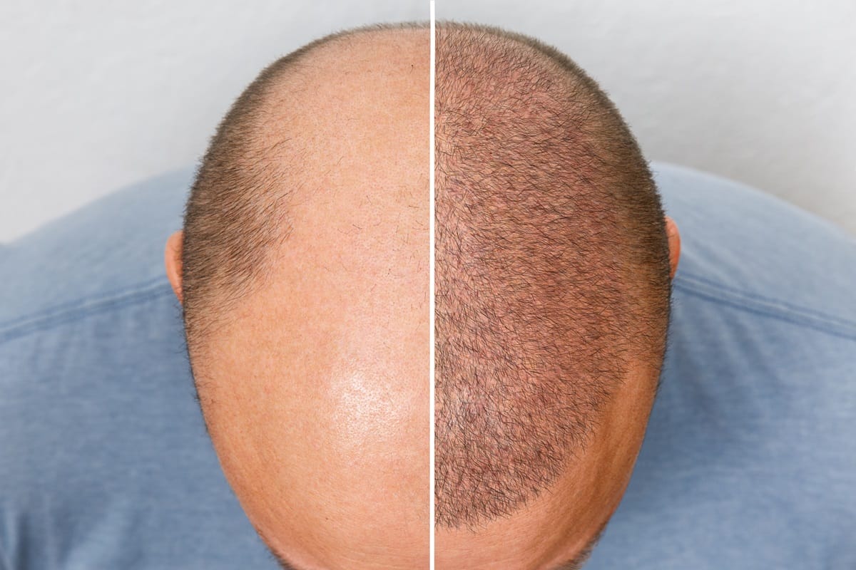 Modern hair transplant techniques compared with past methods