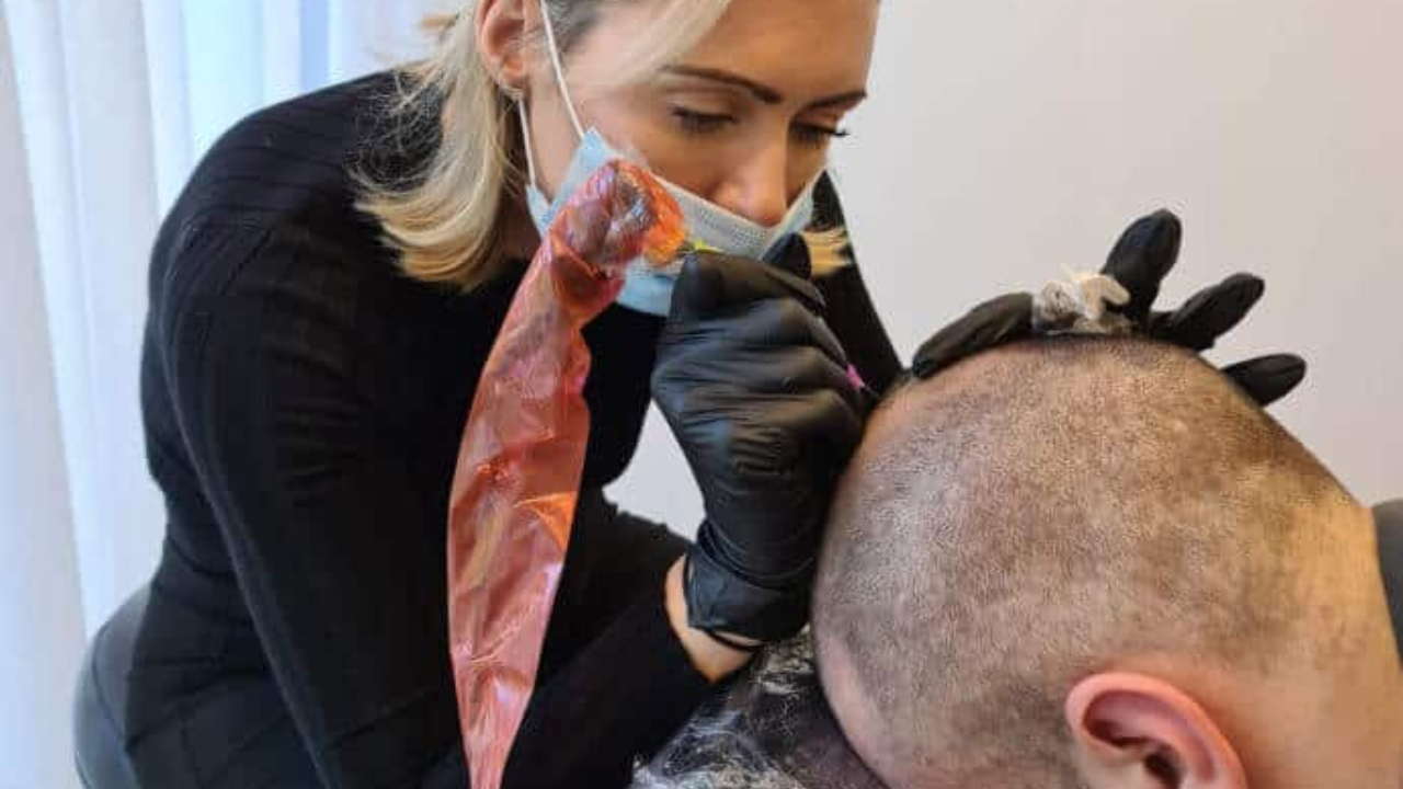 Can SMP and Hair Transplants Be Combined, Foli Sim
