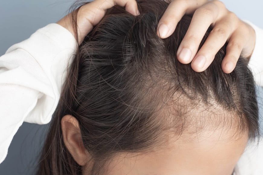 Common Misconceptions About Alopecia