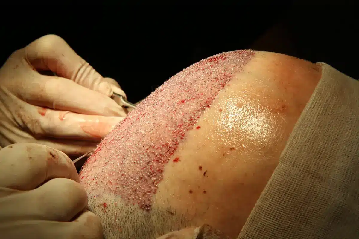 What is a FUE hair transplant?: SMP and hair transplants