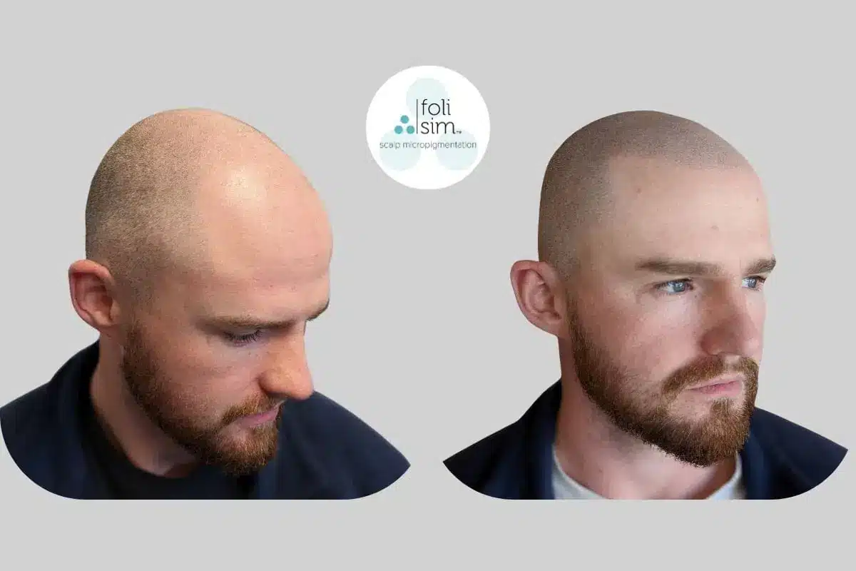 SMP vs Hair Transplant: The Definitive Comparison of Cost, Results, and Longevity