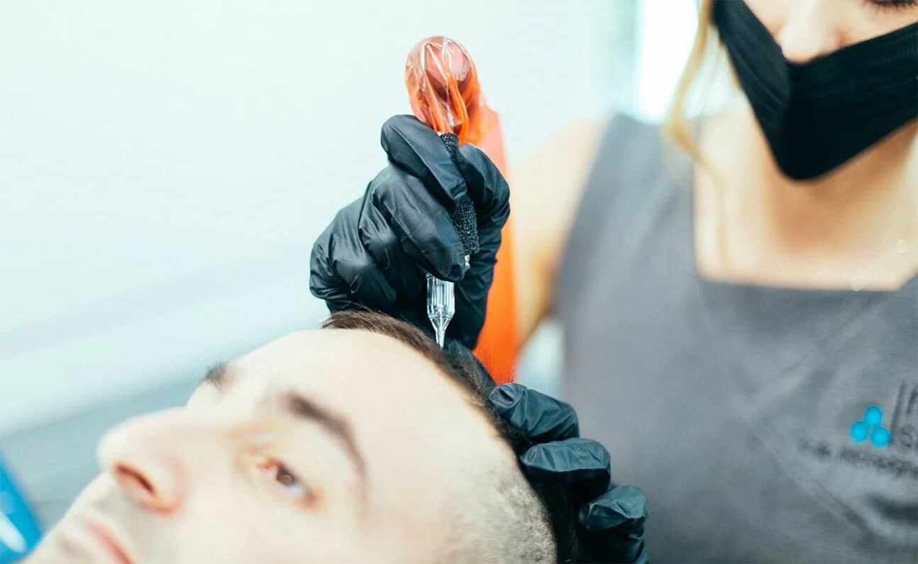 Scalp Micropigmentation: Does it Look Genuine?