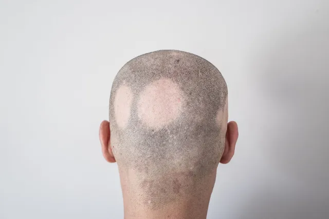 How SMP Can Help with Alopecia and Other Hair Loss Conditions