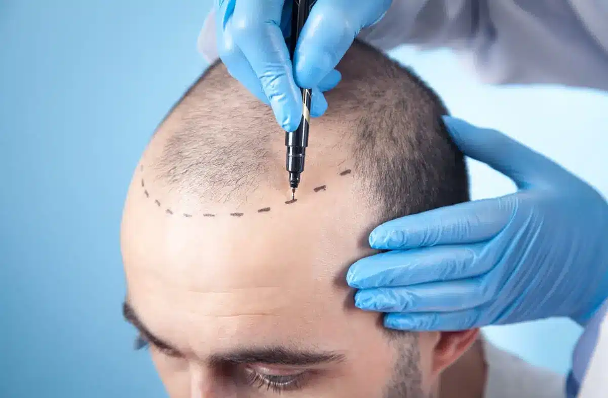 The Latest Hair Loss Treatments To Get Overseas: Why You Should Be Skeptical