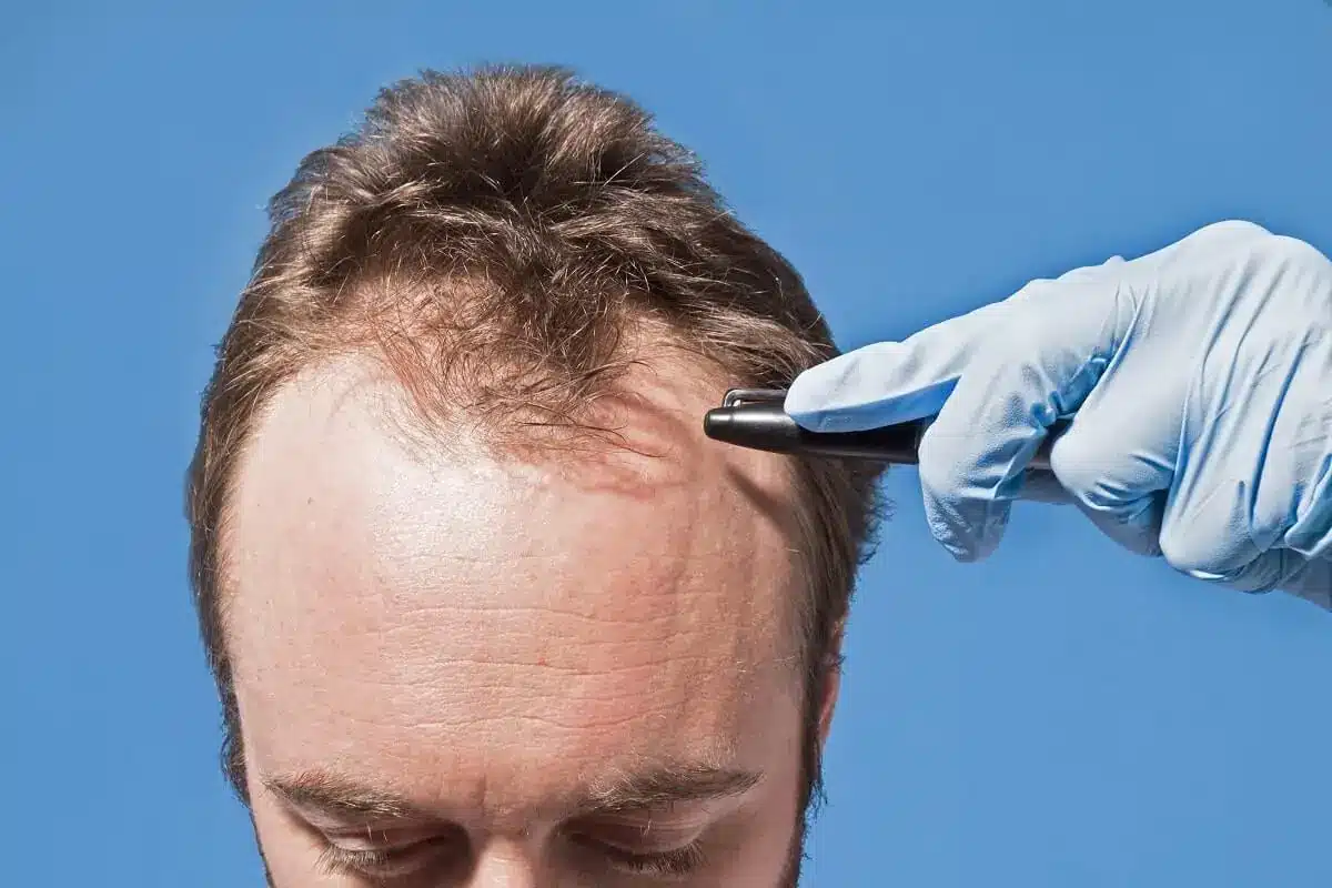 Is the Cure for Hair Loss Coming Soon?