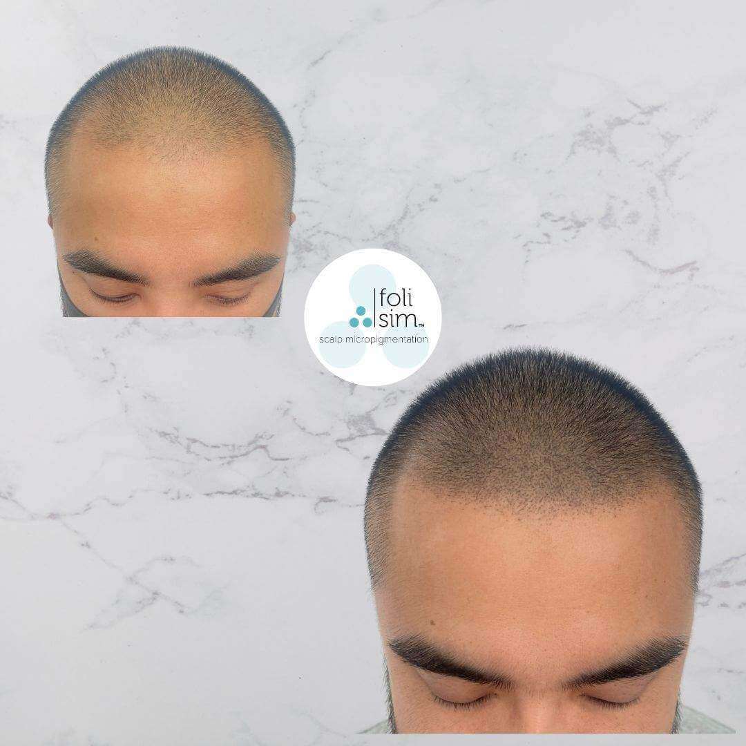 Noninvasive solutions for MShaped Hairline