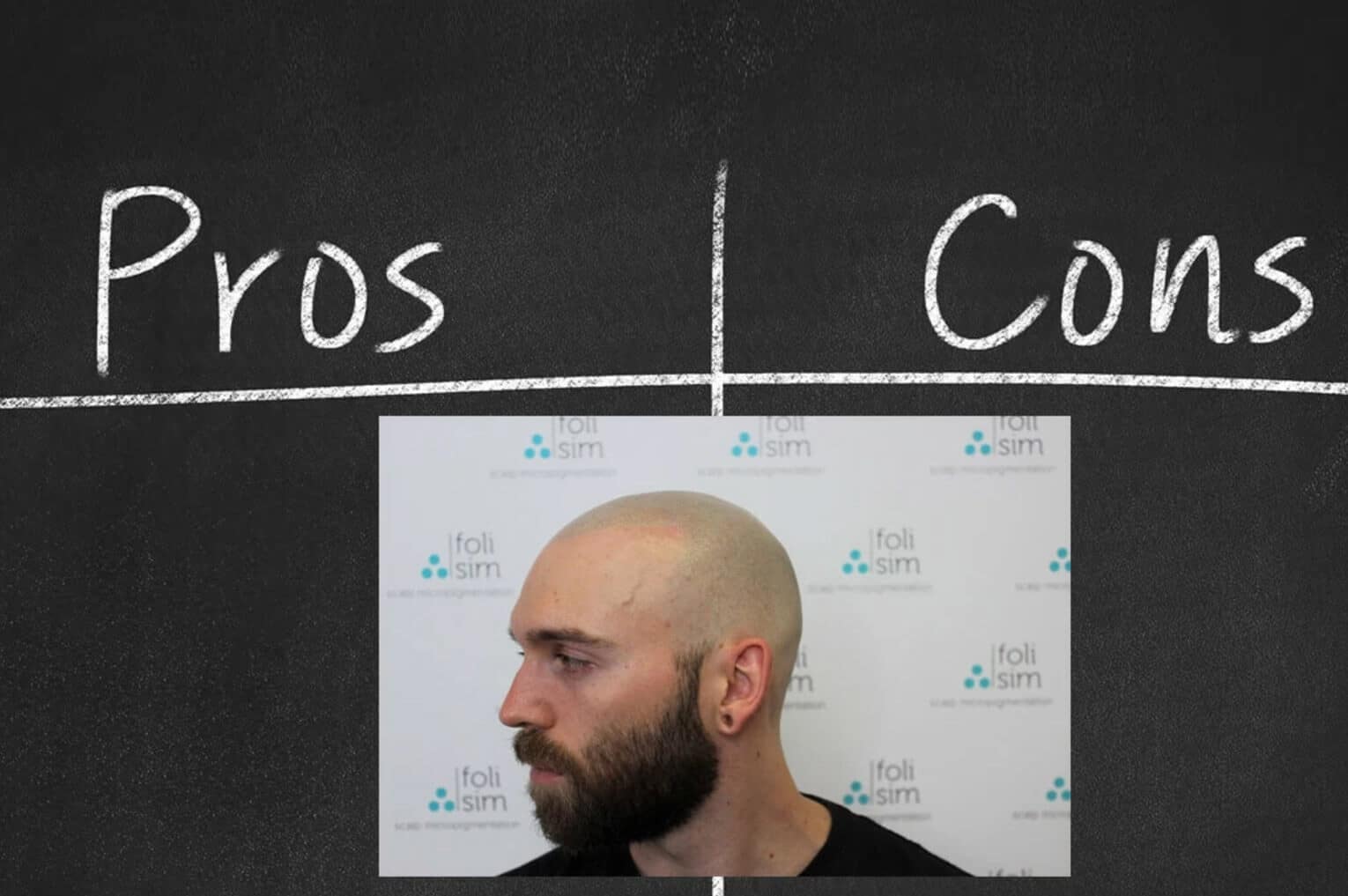 Is Scalp Micropigmentation Worth It? An Honest Review One Year On