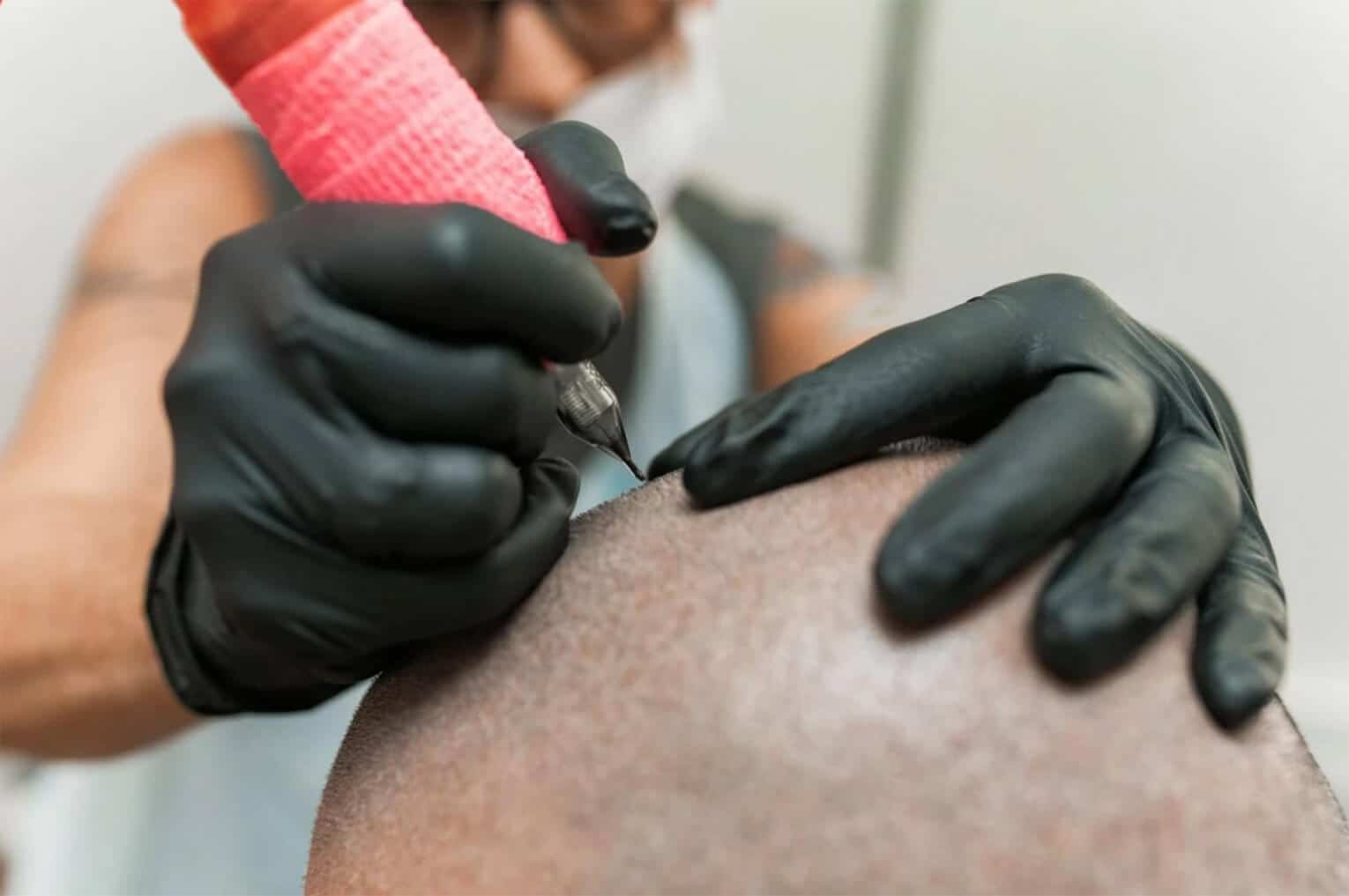 5 Steps to Prepare for Scalp Micropigmentation Treatment Sessions