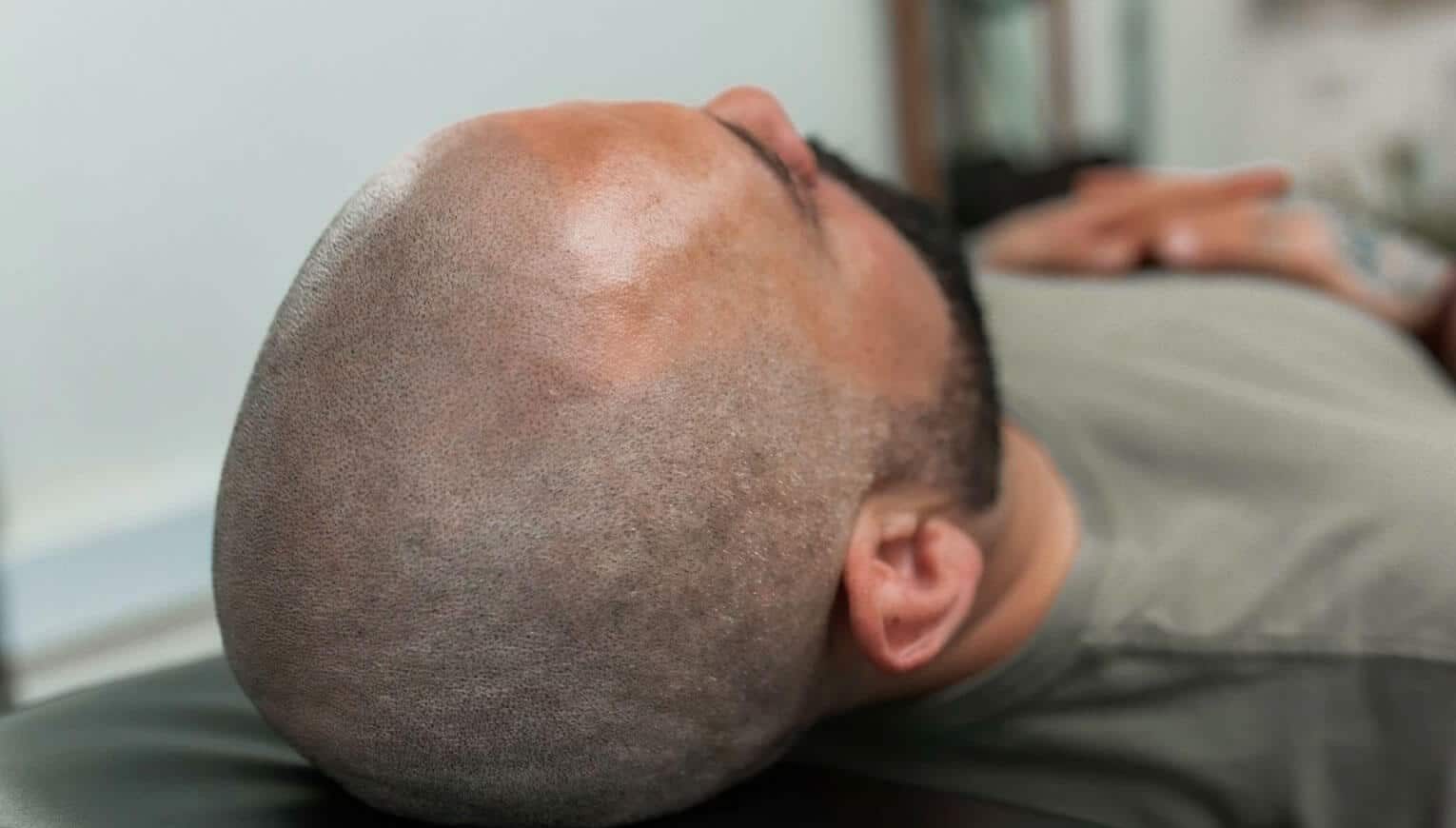 Scalp micropigmemntation evolution, Foli Sim