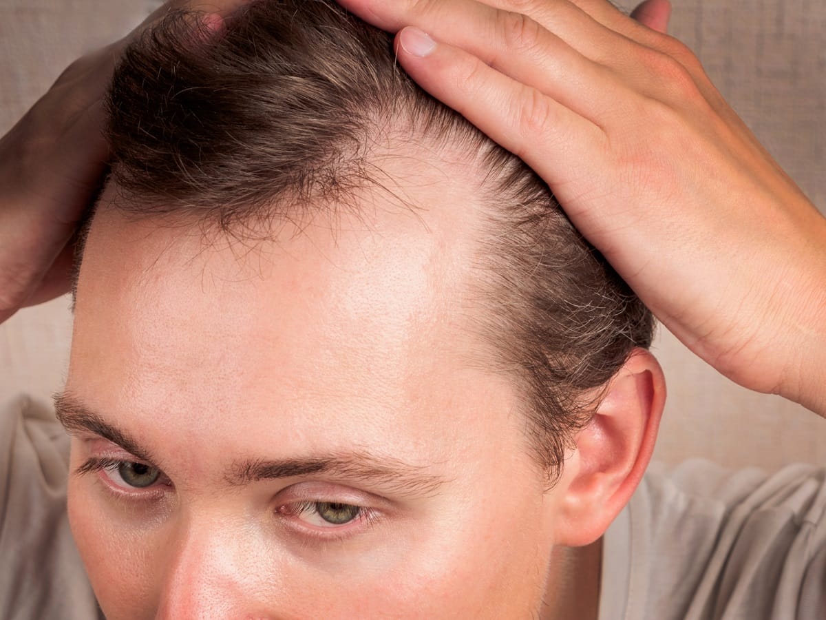 Stress and lifestyle factors MShaped Hairline