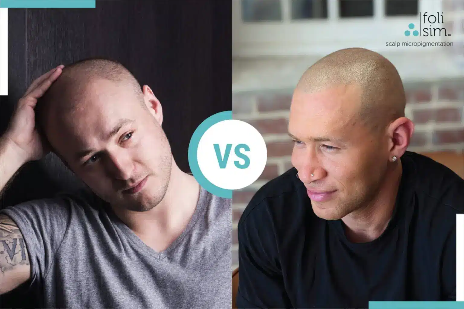 The 5 Biggest Scalp Micropigmentation Regrets