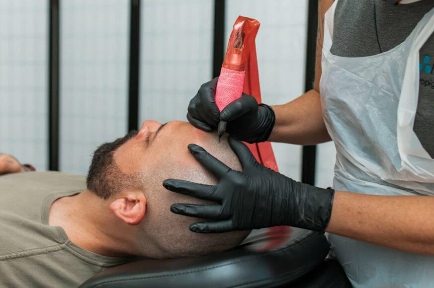 Treatment Options For Alopecia