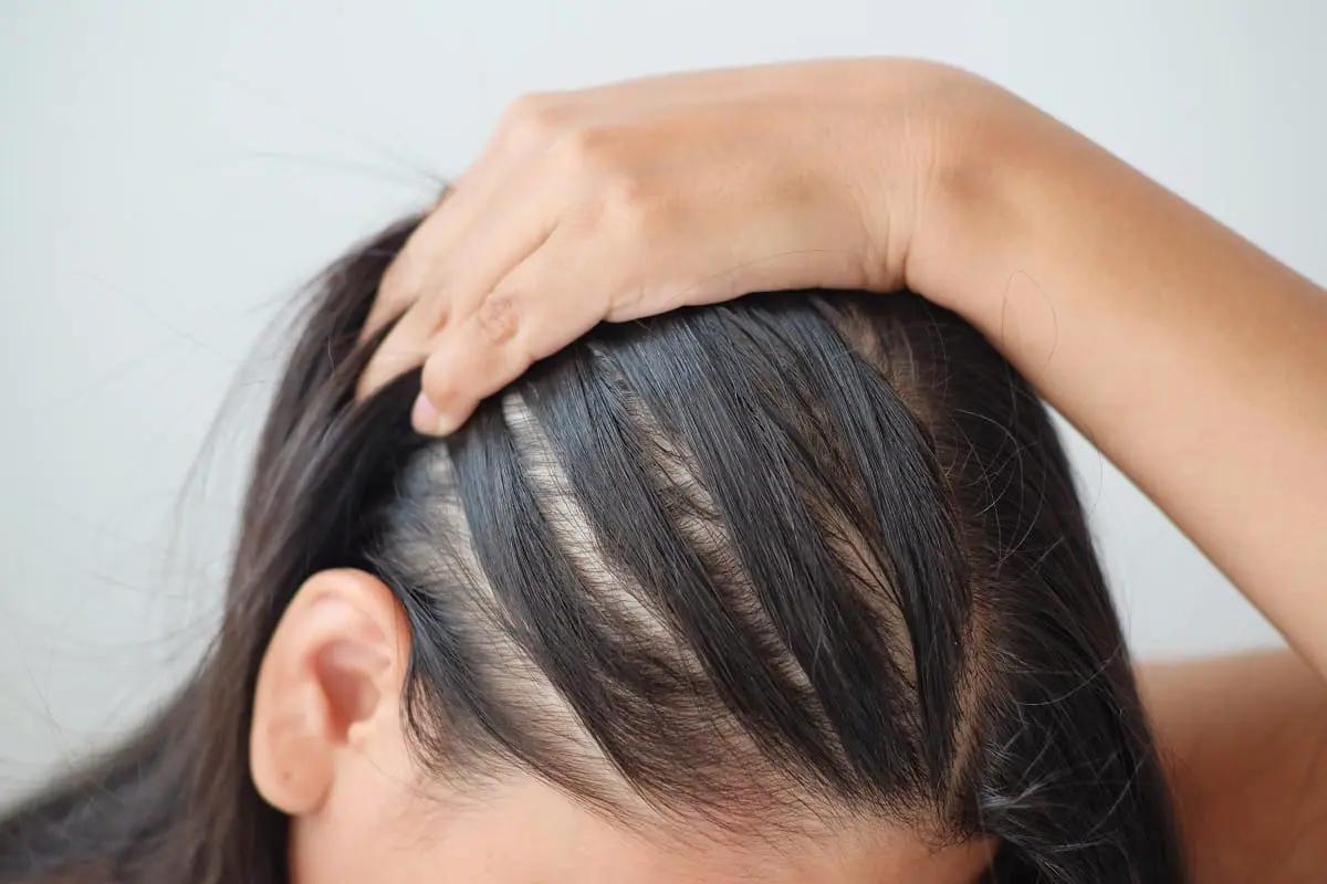 Understanding the Causes of Hair Loss in Women, Foli Sim