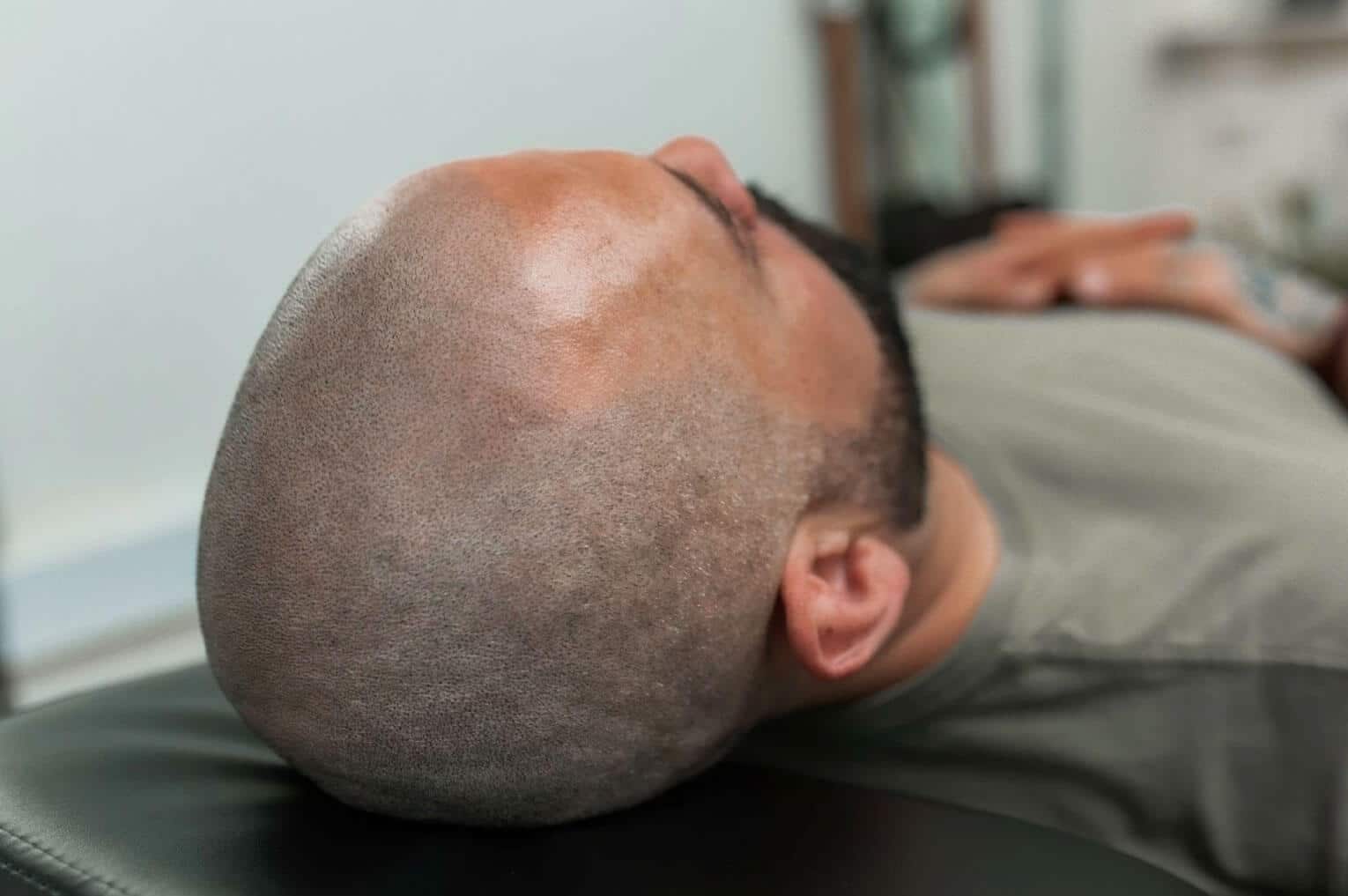 What Does Scalp Micropigmentation Look Like and What Should I Expect?