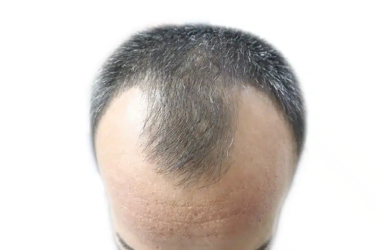 What is an M Shaped Hairline, Foli Sim