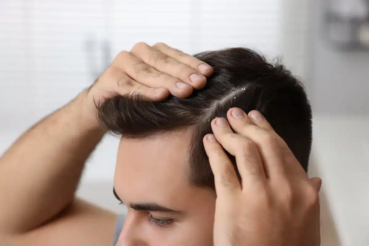 Does Dandruff Cause Hair Loss? Tips to Protect Your Scalp