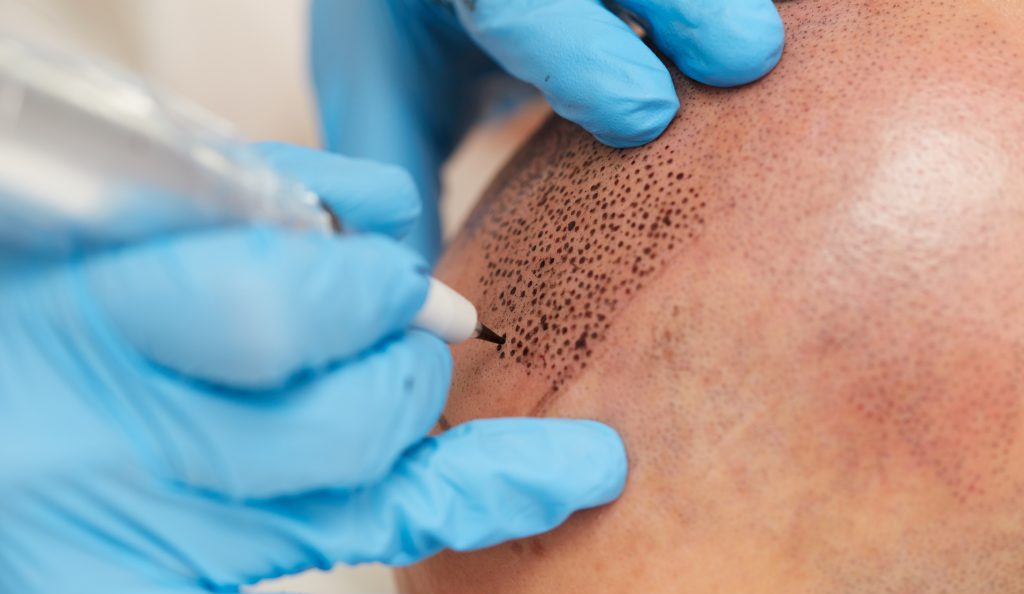 History of scalp micropigmentation, Foli Sim