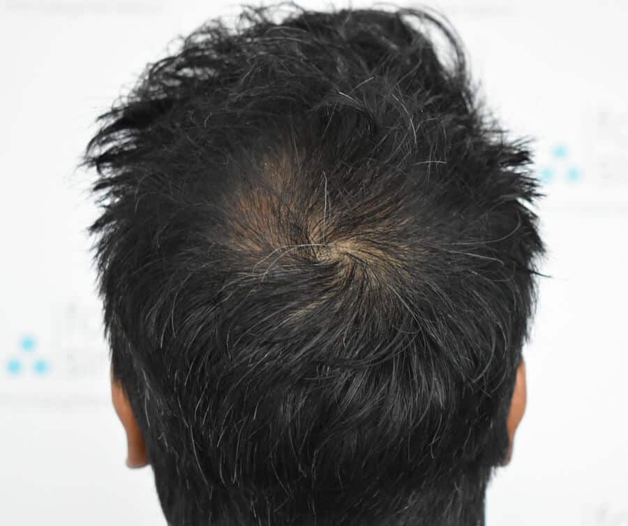 Back view of a man's dark, short hair showing the crown swirl with a lightly thinned patch blended into surrounding hair.