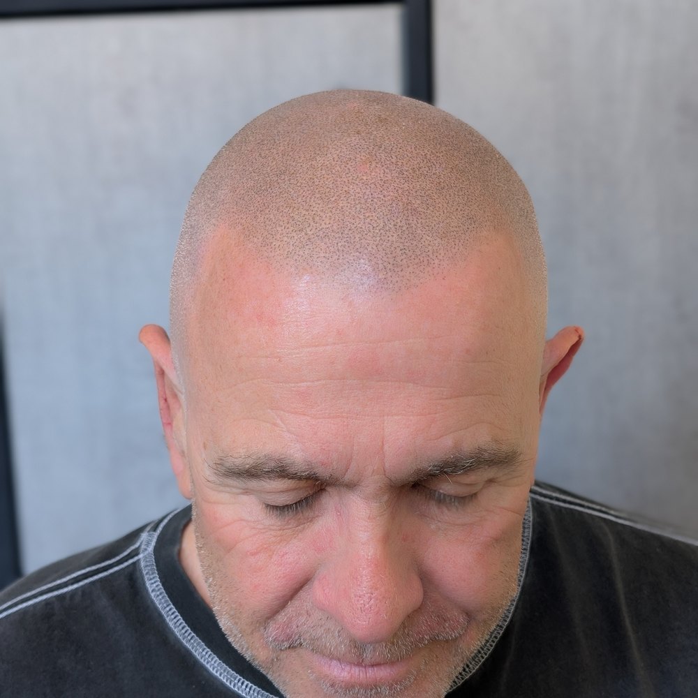Man with a closely shaved head seen from above, showing evenly stippled pigment dots across the scalp and a defined hairline.