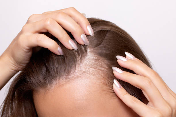What women with frontal thinning should know about SMP in Melbourne