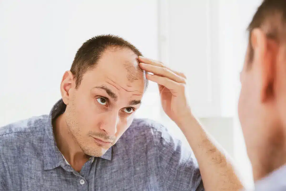 A Comprehensive Guide to Understanding Male Pattern Baldness and the Norwood Scale