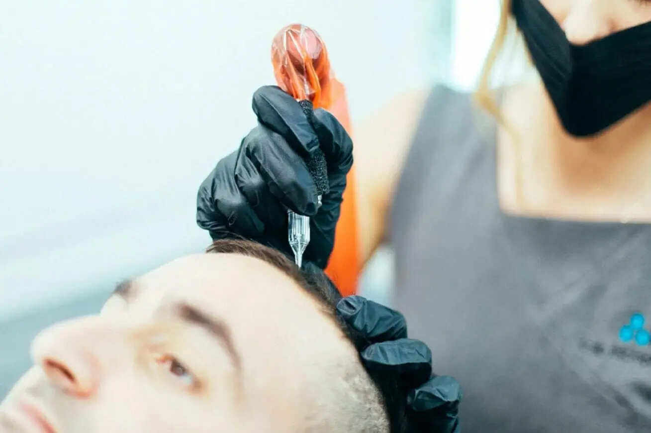 What actually happens when SMP covers a scalp scar
