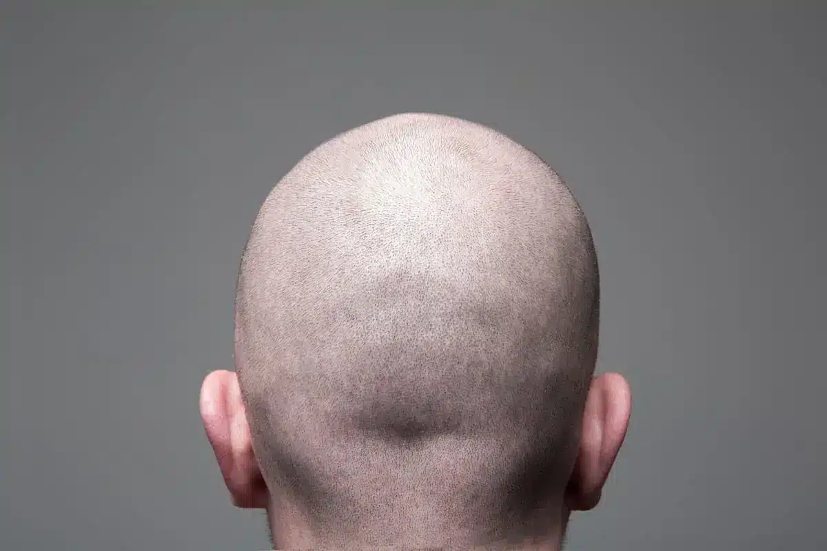 Do You Have To Shave Your Head For Scalp Micropigmentation? Unveiling the Versatility of Scalp Micropigmentation