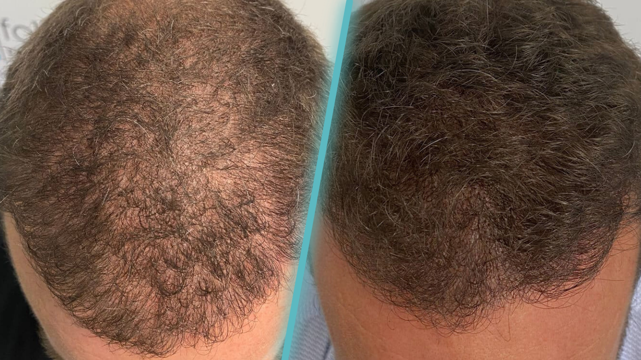 SMP for Hair Density in Perth: Before and After Examples