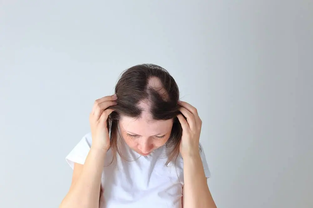 Understanding Alopecia: Causes, Prevention, and Treatment