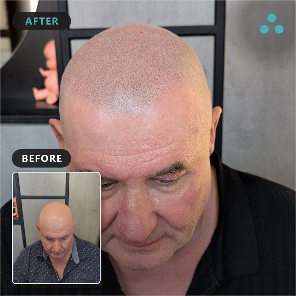 Older man looking down, showing a scalp with fine stubble-like pigment dots after SMP