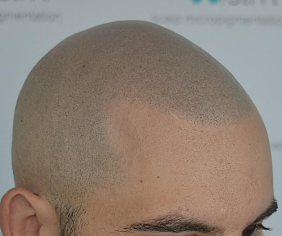 SMP hairline result (after)