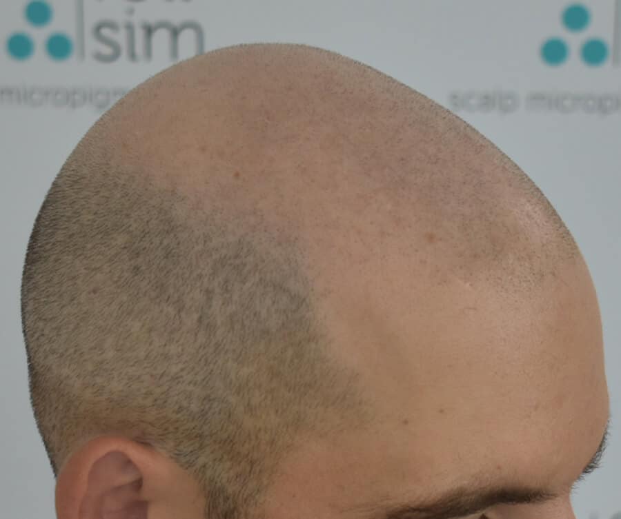 SMP hairline result (before)