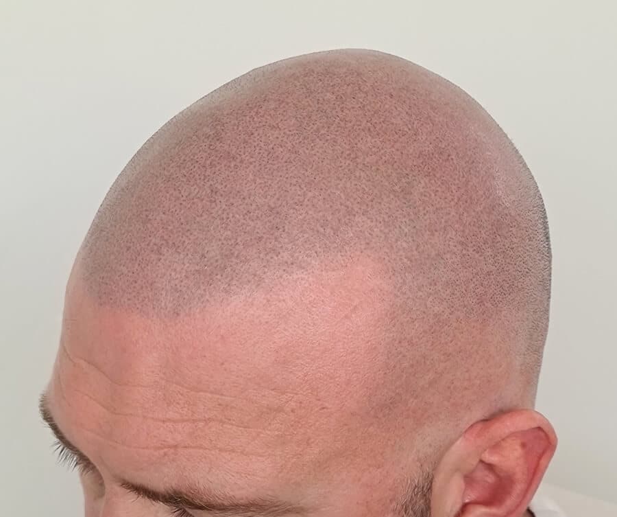Buzz-cut SMP result (after)