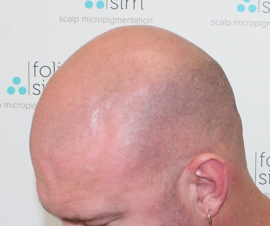 Buzz-cut SMP result (before)