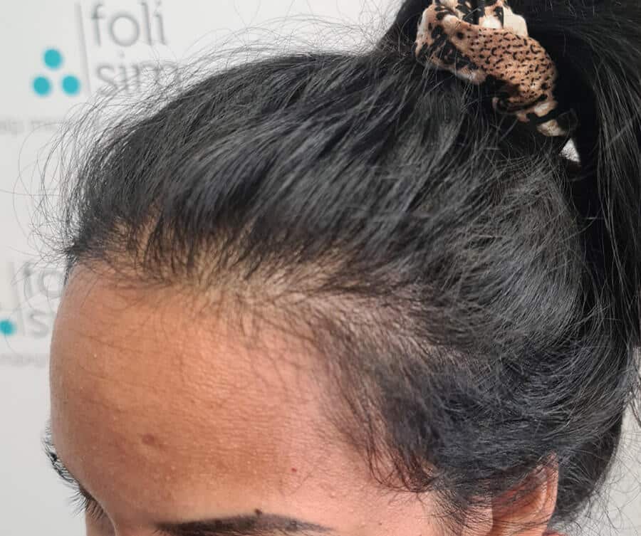SMP for thinning hair result (before)