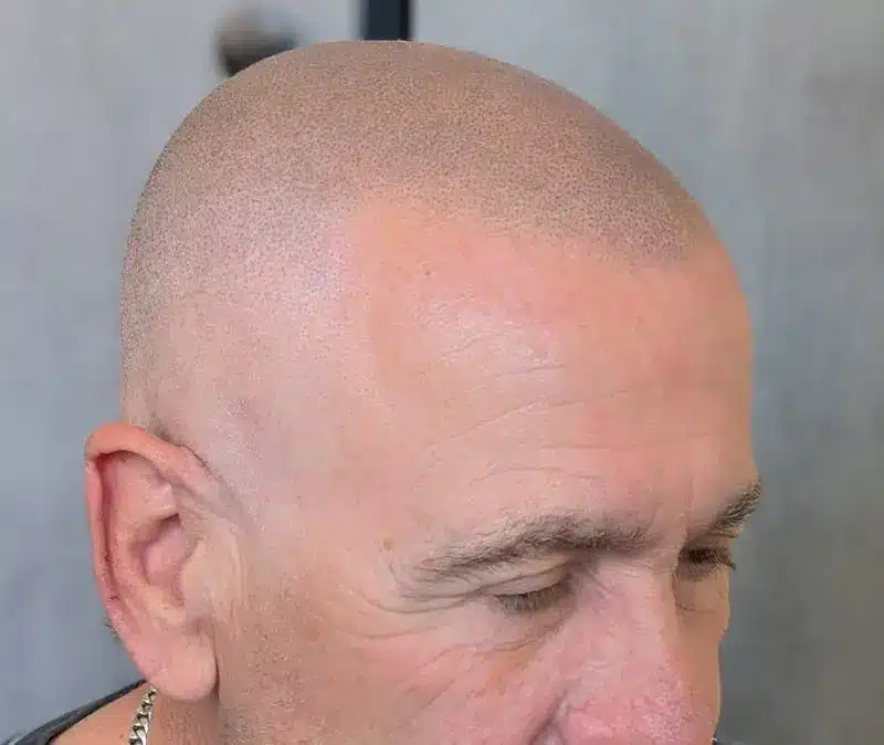 Scalp Micropigmentation Perth: Hair Tattoo Clinic in Fremantle result 1