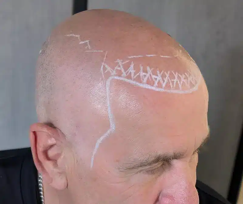 Scalp Micropigmentation Perth: Hair Tattoo Clinic in Fremantle before 1