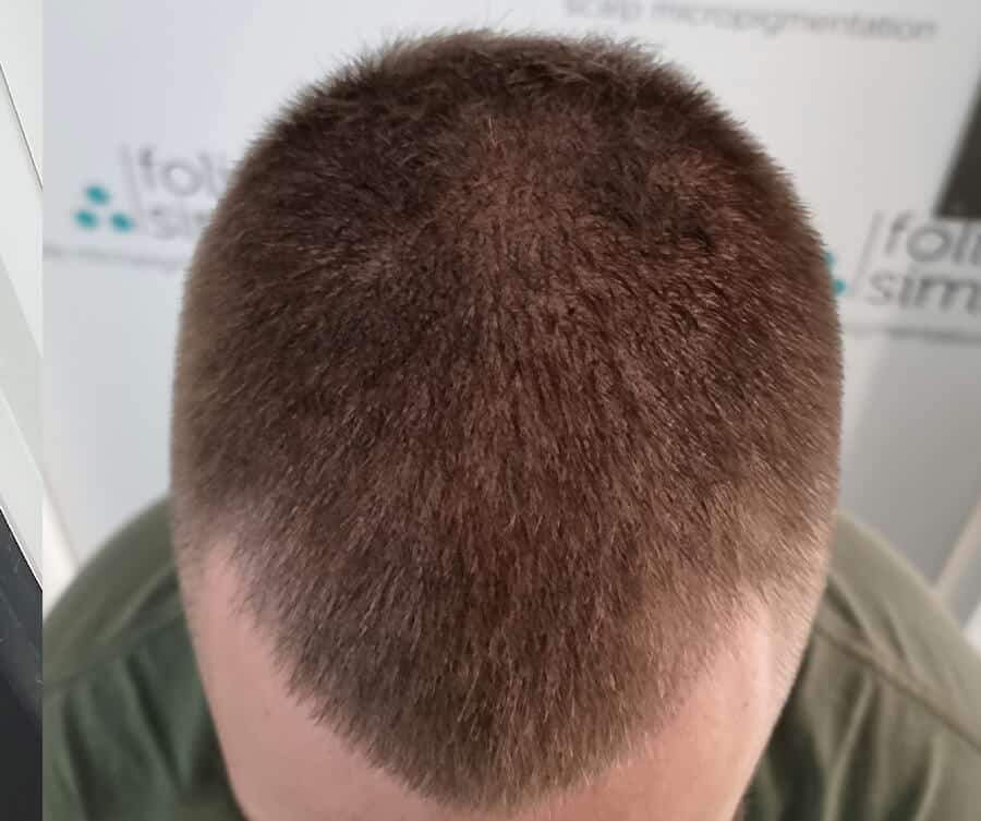 Thinning hair 1 (after), Foli Sim