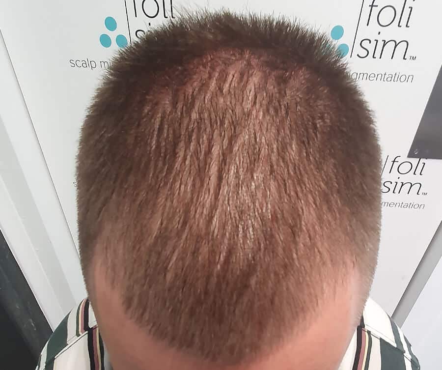 Thinning hair 1 (before), Foli Sim