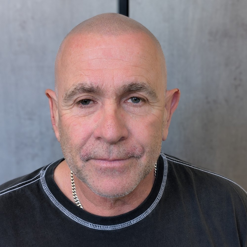 Scalp Micropigmentation Sydney result