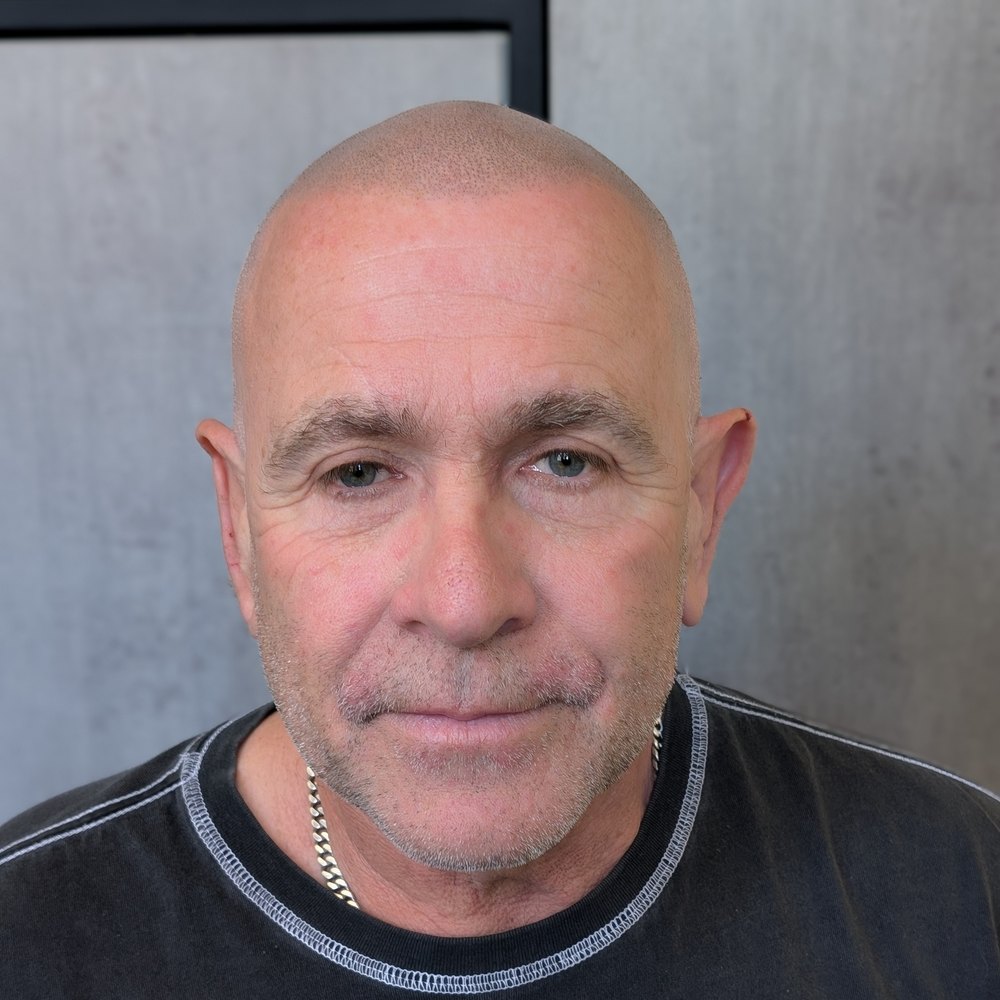 A Foli Sim client with a natural, defined hairline after scalp micropigmentation
