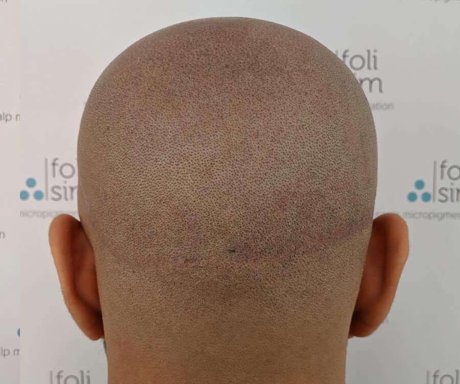 Scalp micropigmentation for scar (after), Foli Sim