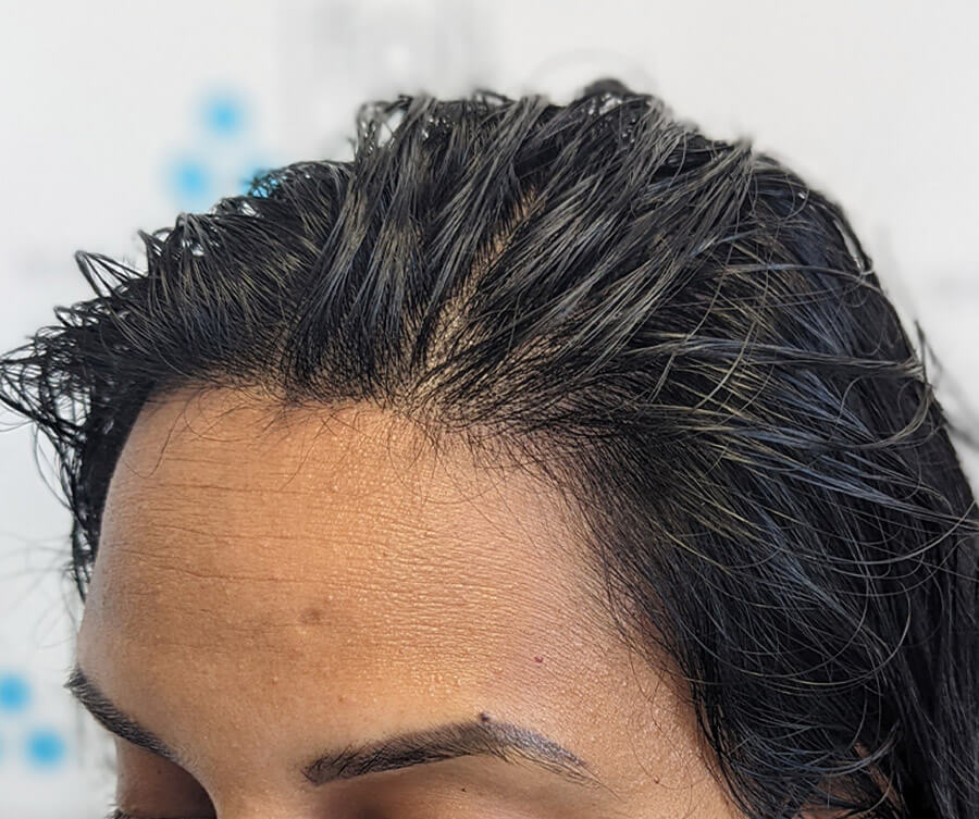 Scalp micropigmentation women (after), Foli Sim
