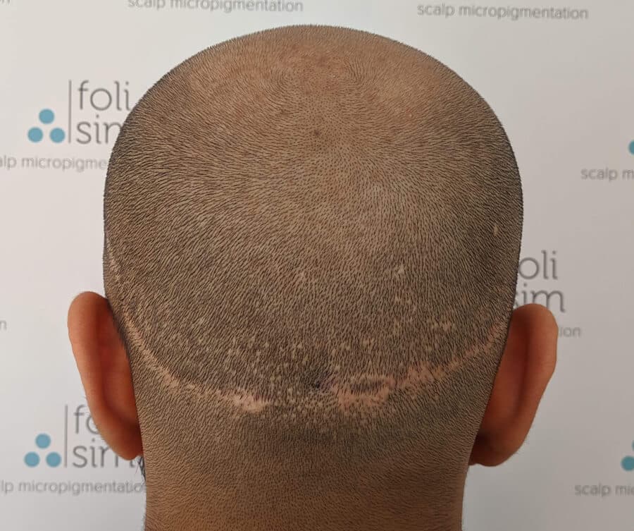 Scalp micropigmentation for scar (before), Foli Sim