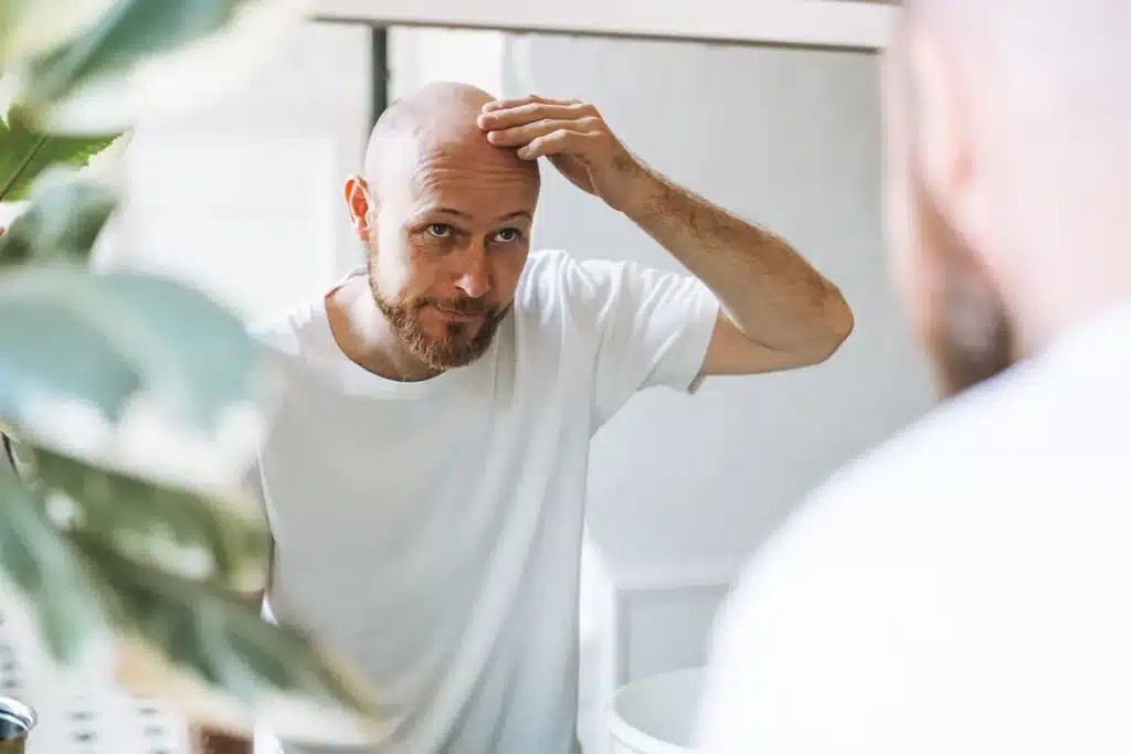 Man losing his hair, Foli Sim