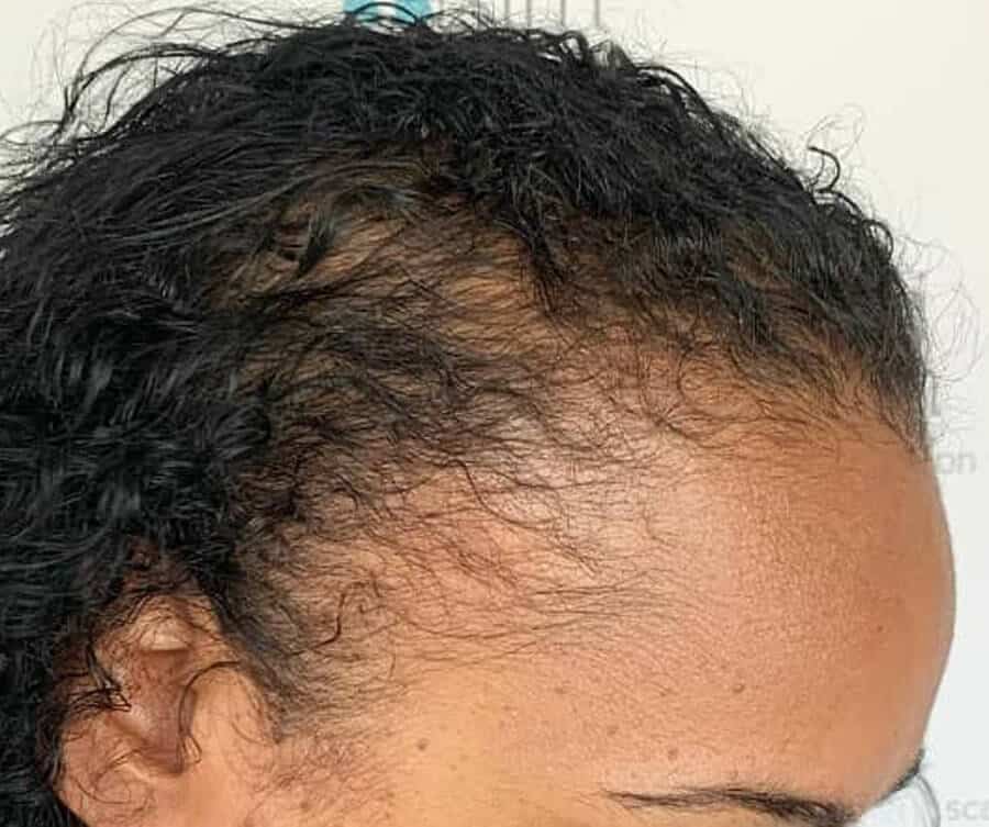 Scalp micropigmentation women (before), Foli Sim