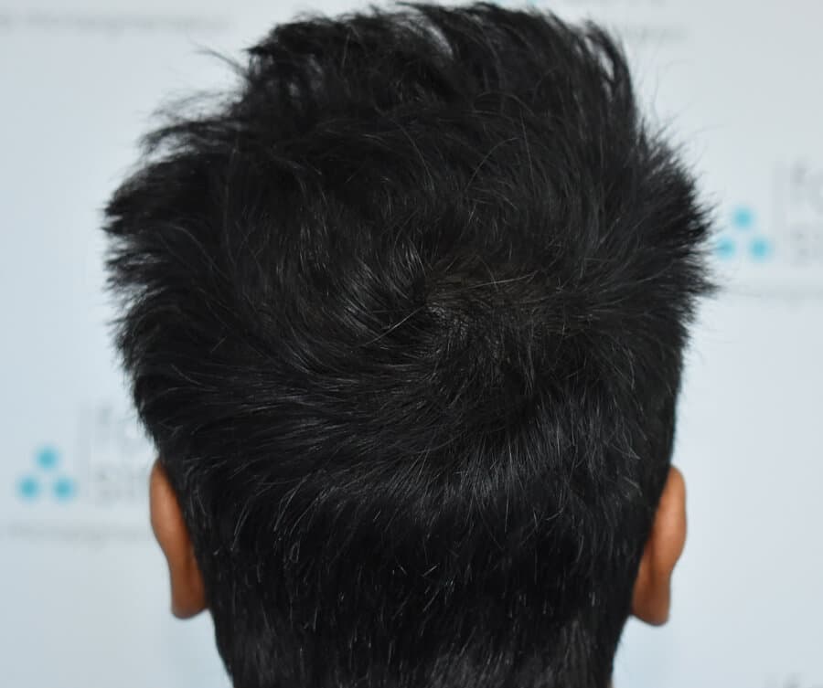Thinning hair 2 (after), Foli Sim